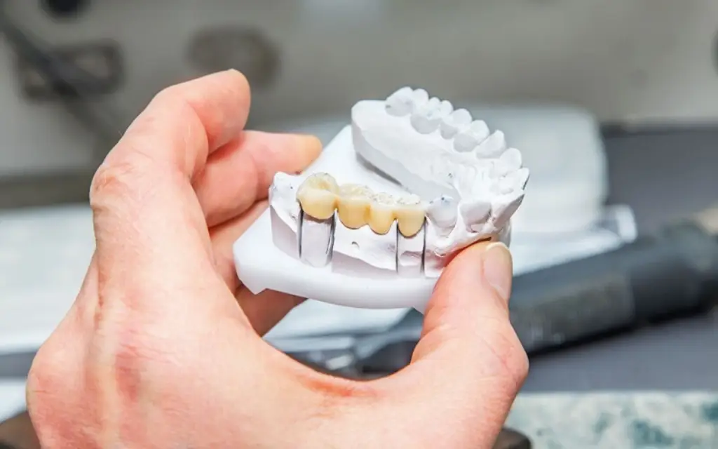Implantes dentales la mejor alternativa