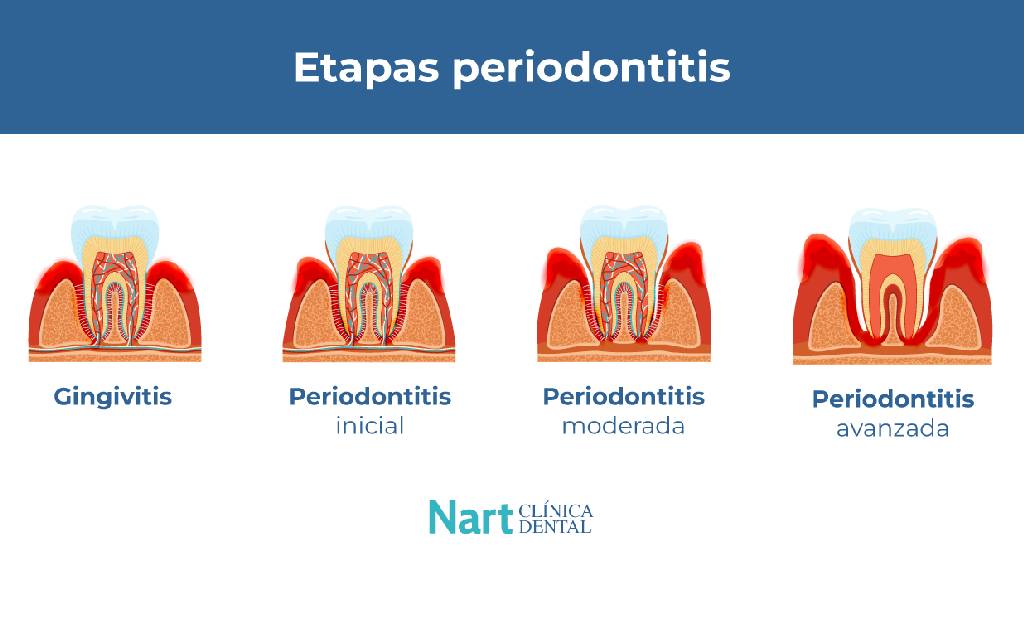 Etapas De La Enfermedad Periodontal Etapas De La Enfermedad Periodontal