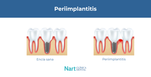 periimplantitis