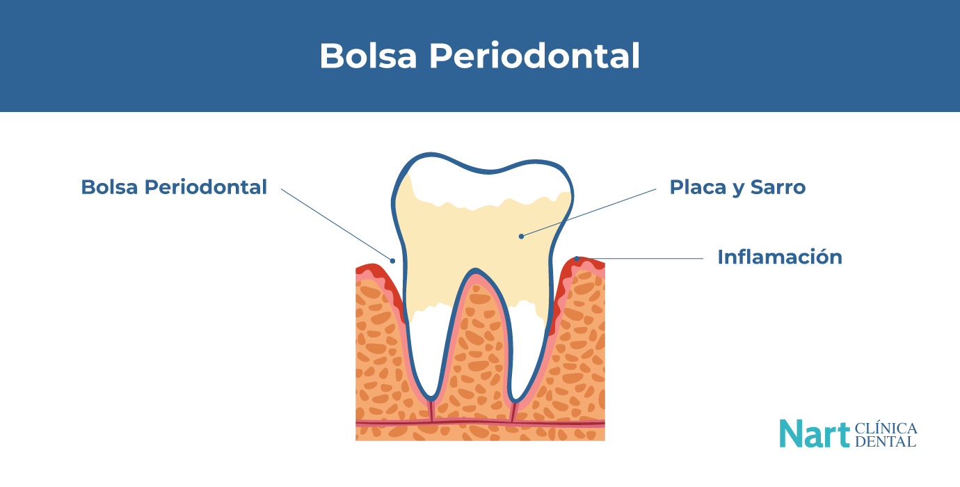Bolsa periodontal
