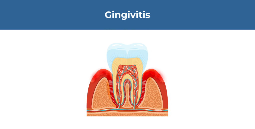 Gingivitis