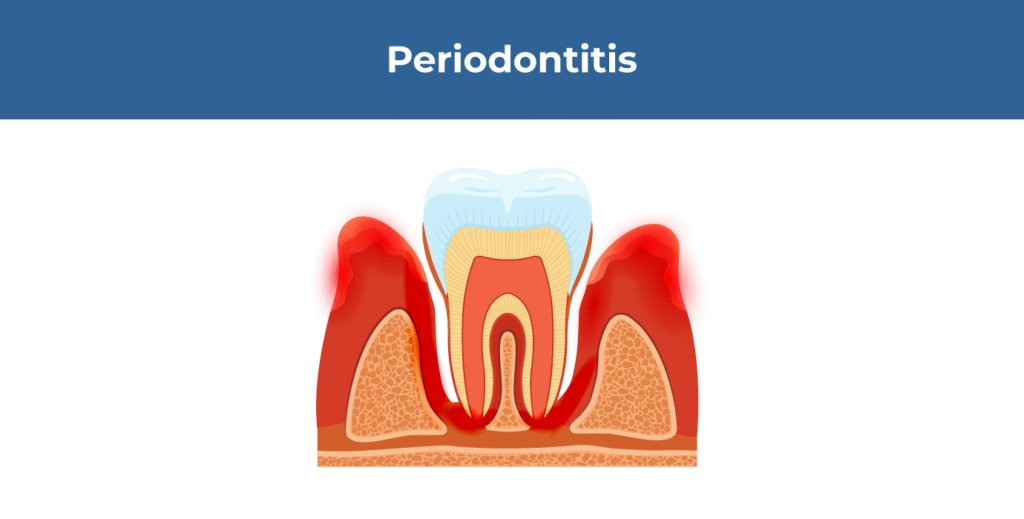 periodontitis