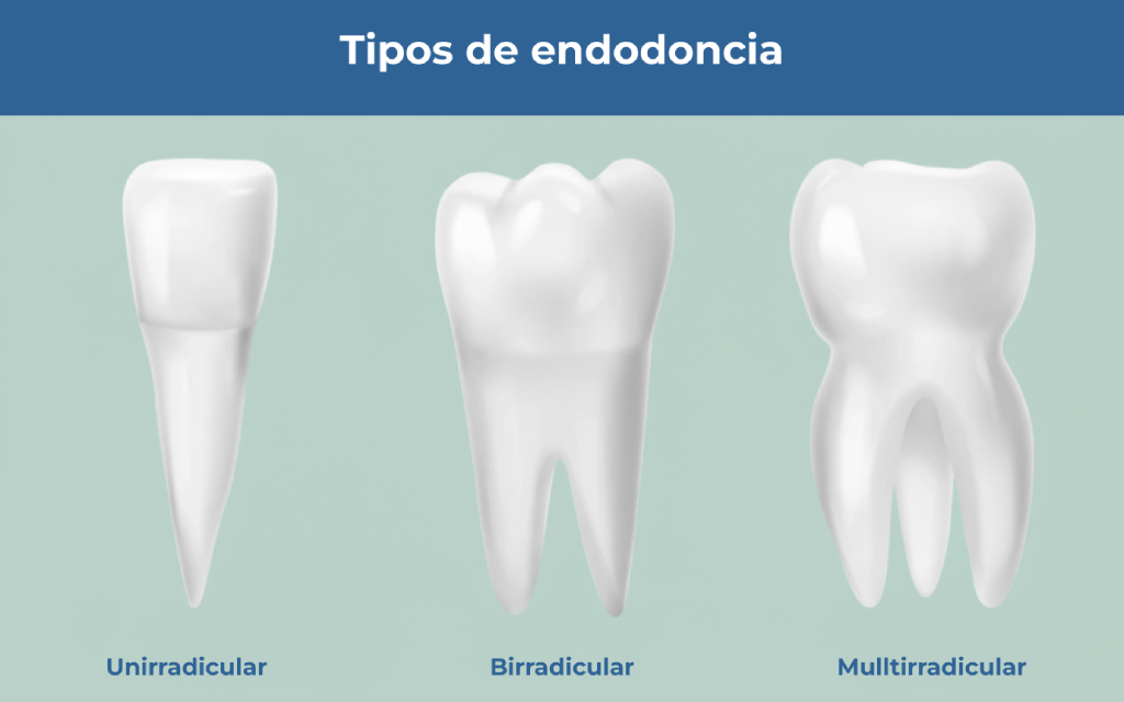 Diferencia entre endodoncia unirradicular, birradicular y multirradicular 