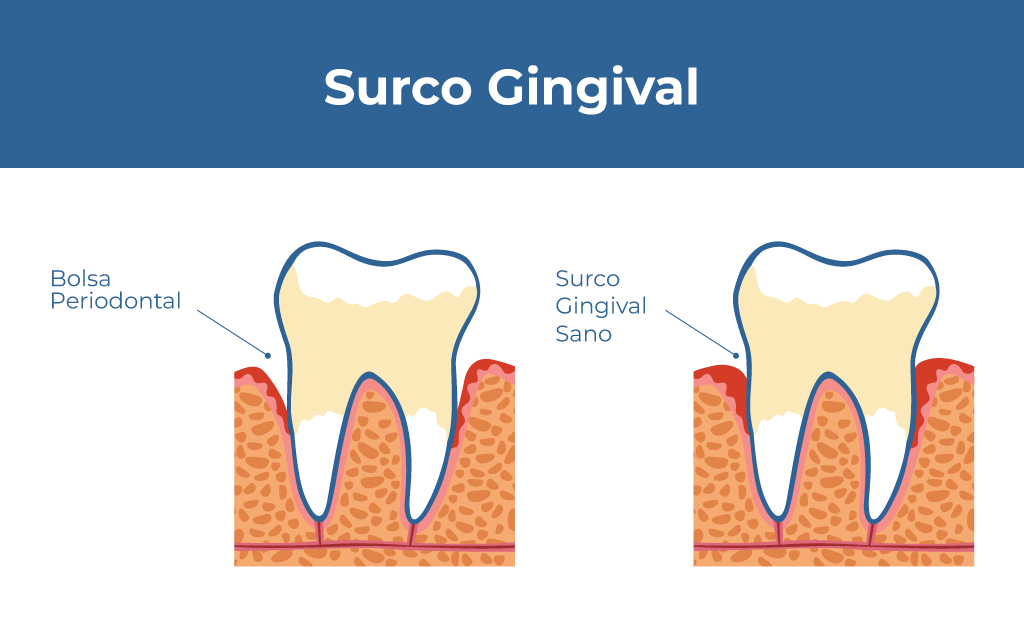 Surcofen El surco gingival sano: su importancia y cómo cuidarlo