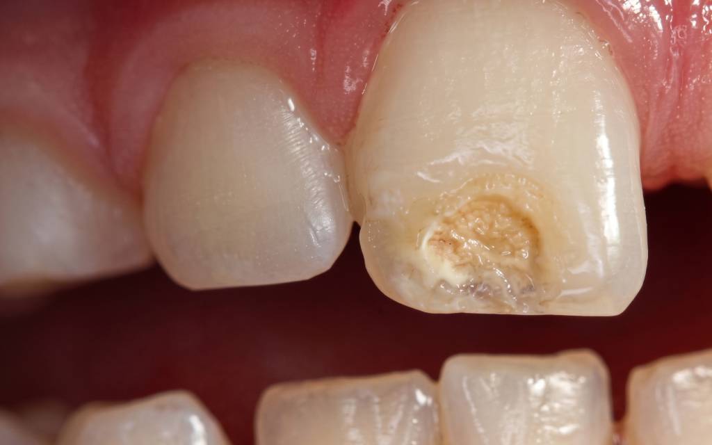  hipoplasia dental grave