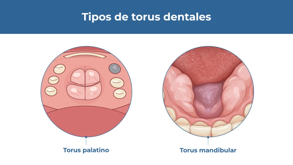 tipos de torus dental